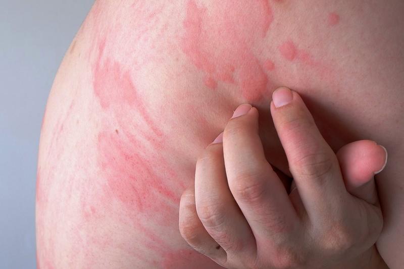 Naturalne sposoby na rumień guzowaty