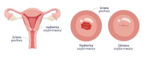 Jak radzić sobie z nadżerką po porodzie naturalnym? Praktyczne porady dla mam
