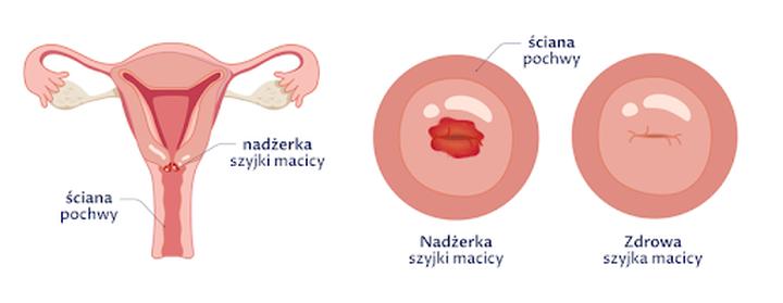Jak radzić sobie z nadżerką po porodzie naturalnym? Praktyczne porady dla mam