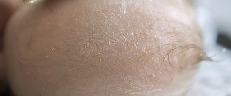 Ciemieniucha u niemowląt