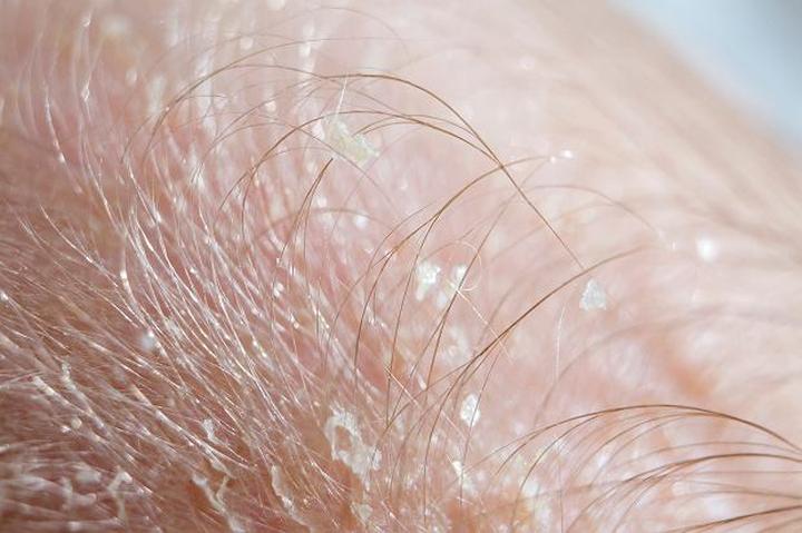 Leczenie ciemieniuchy