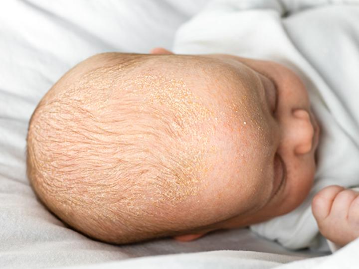 Pielęgnacja skóry głowy dziecka