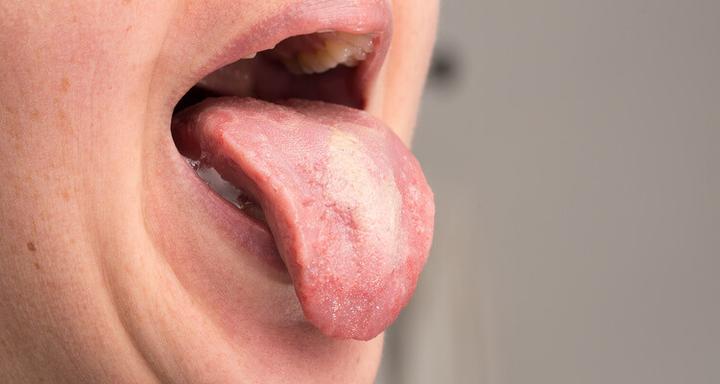 Pleśniawki u dzieci