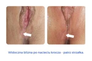 Jak radzić sobie z naciętym krocze po porodzie – porady i wsparcie dla młodych mam