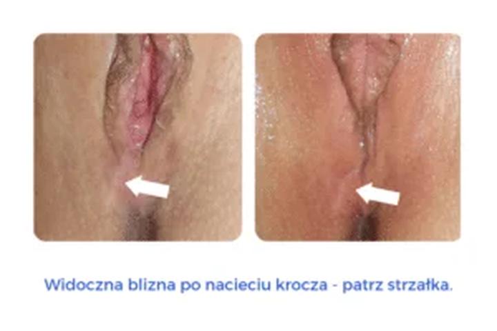 Jak radzić sobie z naciętym krocze po porodzie – porady i wsparcie dla młodych mam