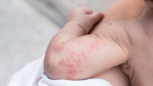 Jak radzić sobie z pokrzywką u noworodka po porodzie?