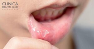 Pleśniawki u dzieci – jak je rozpoznać? Zobacz zdjęcia!