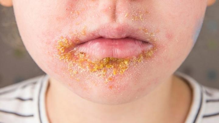 Leczenie gronkowca po porodzie