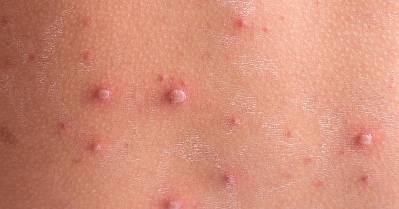 Ospa wietrzna u niemowlaka