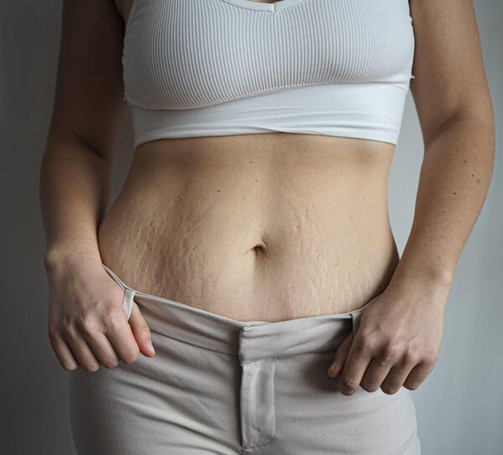 Profesjonalne zabiegi na rozstępy