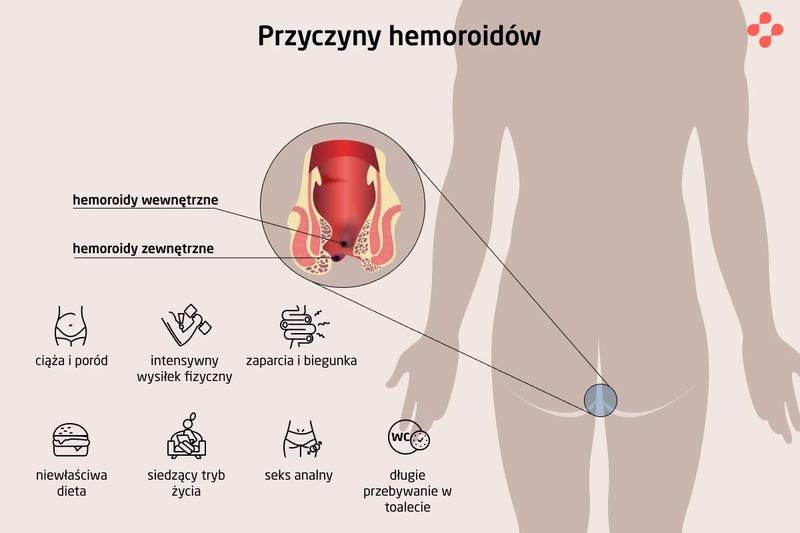 Zapobieganie hemoroidom w ciąży