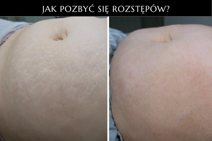 Zioła i oleje na rozstępy