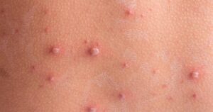 Jak radzić sobie z ospą wietrzną u niemowlaka karmionego piersią?