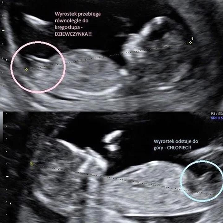 Kiedy fachowiec się myli: czy lekarz może pomylić płeć dziecka?