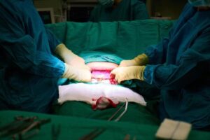 Kiedy i jak przebiega zdejmowanie szwów po porodzie? Porady dla świeżo upieczonych mam