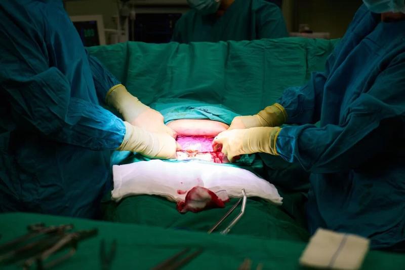 Kiedy i jak przebiega zdejmowanie szwów po porodzie? Porady dla świeżo upieczonych mam