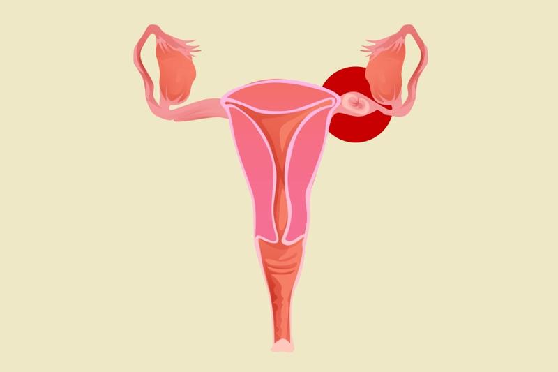 Diagnostyka i leczenie ciąży pozamacicznej