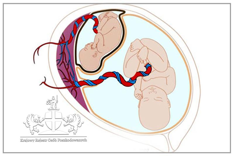 Dieta wspierająca płodność a ciąża bliźniacza