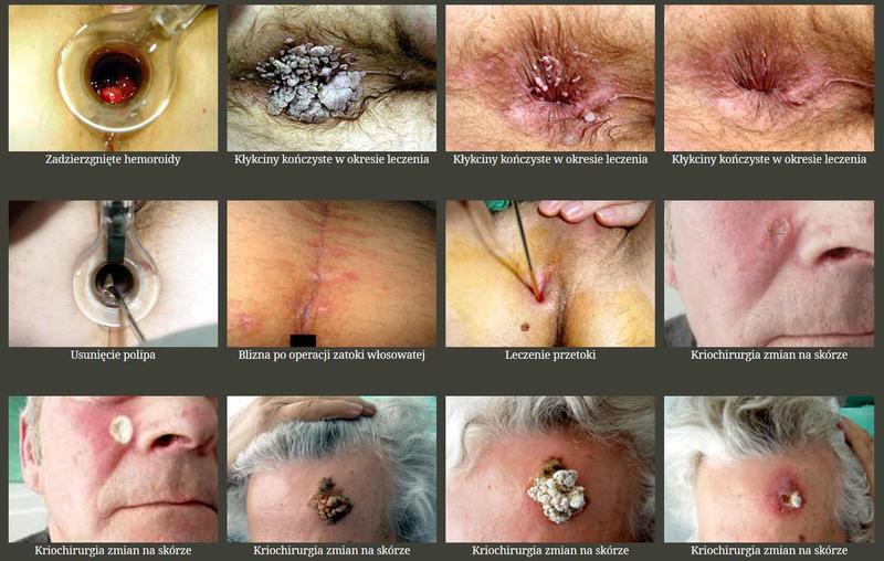 Leki i suplementy na żylaki