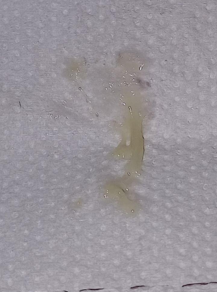 Niepokojące zmiany śluzu w ciąży