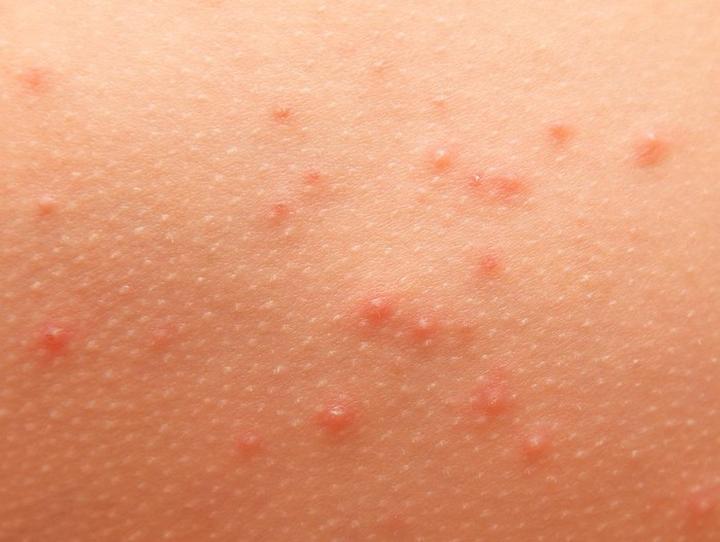 Objawy alergii skórnej