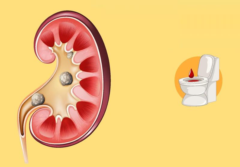 Profilaktyka zakrzepicy poporodowej