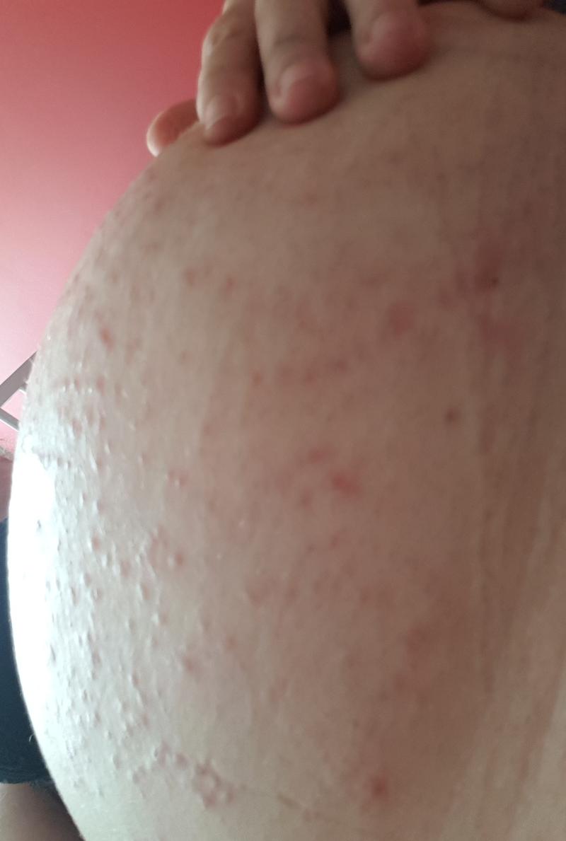 Przyczyny wysypki u ciężarnych