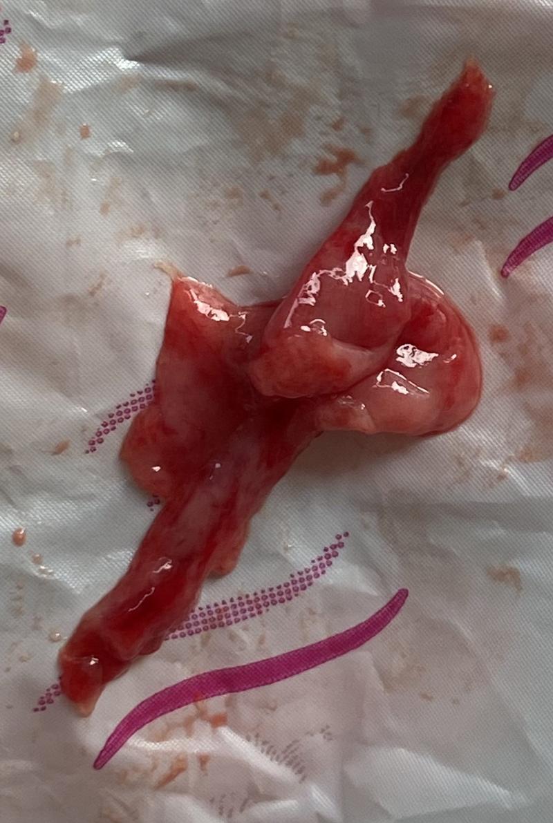 Skrzepy krwi po porodzie