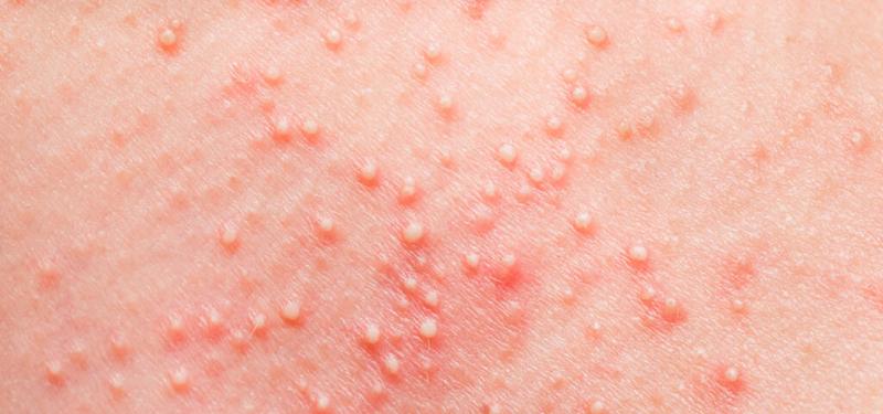 Wysypka alergiczna u dzieci