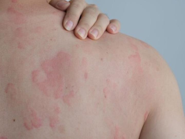 Zdjęcia wysypki alergicznej