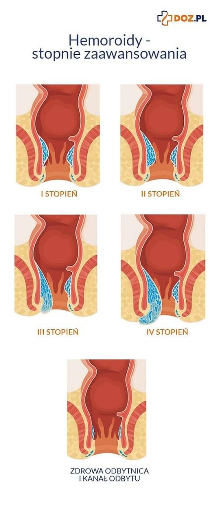 Żylaki odbytu po porodzie