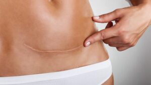 Blizna po nacięciu krocza: jak radzić sobie po porodzie naturalnym?