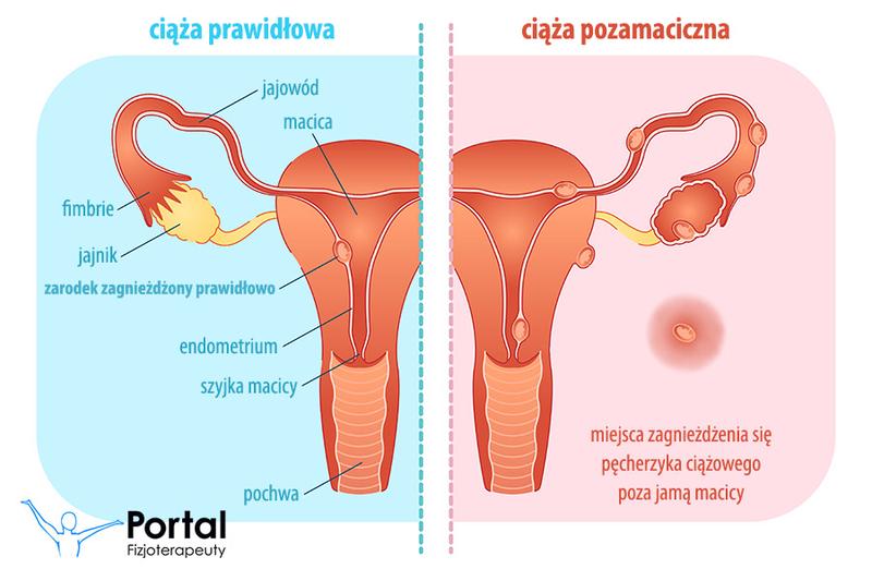Ciąża pozamaciczna: Przewodnik wizualny z informacjami i zdjęciami