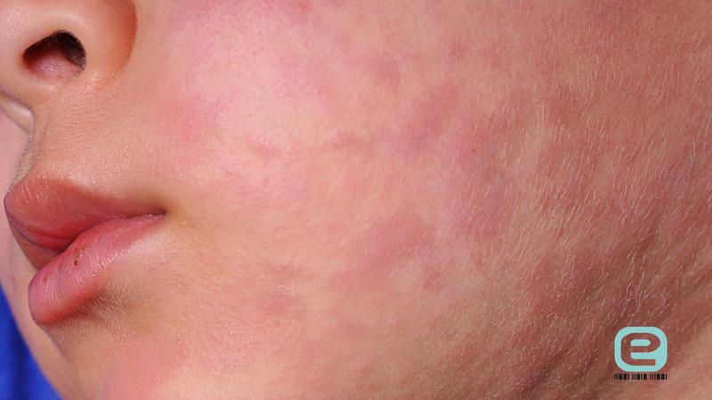 Jak rozpoznać wysypkę alergiczną u dzieci? Przykładowe zdjęcia dla rodziców