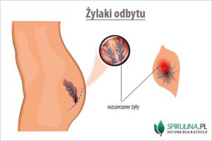 Jak skutecznie radzić sobie z żylakami odbytu po porodzie? Przewodnik po leczeniu i ulgach.