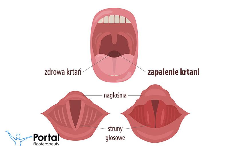Leczenie zapalenia krtani w domu