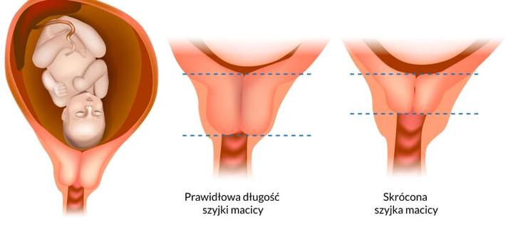 Objawy wczesnej ciąży