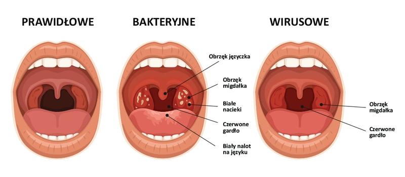 Objawy zapalenia krtani u dzieci