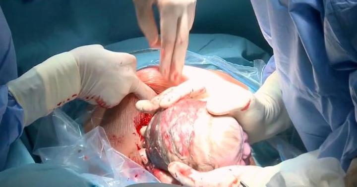 Różnice między porodem naturalnym a cesarskim cięciem