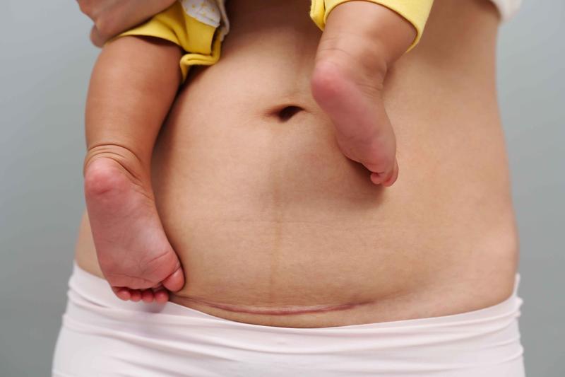 Wsparcie emocjonalne i psychiczne po cesarskim cięciu