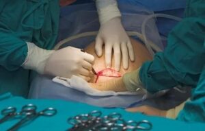 Jakie możliwości ma mama po cesarskim cięciu – poród naturalny czy kolejna operacja?