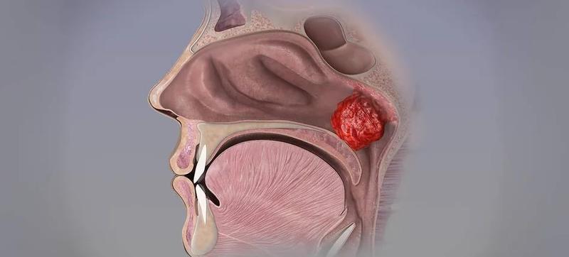 Diagnostyka trzeciego migdała