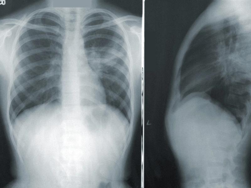 Domowe sposoby na łagodzenie objawów