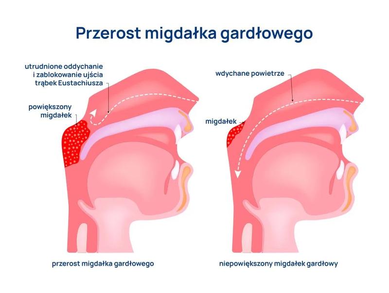 Leczenie przerośniętego trzeciego migdała