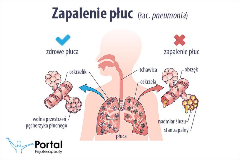 Objawy zapalenia płuc