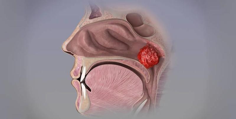Przerost trzeciego migdała u dzieci