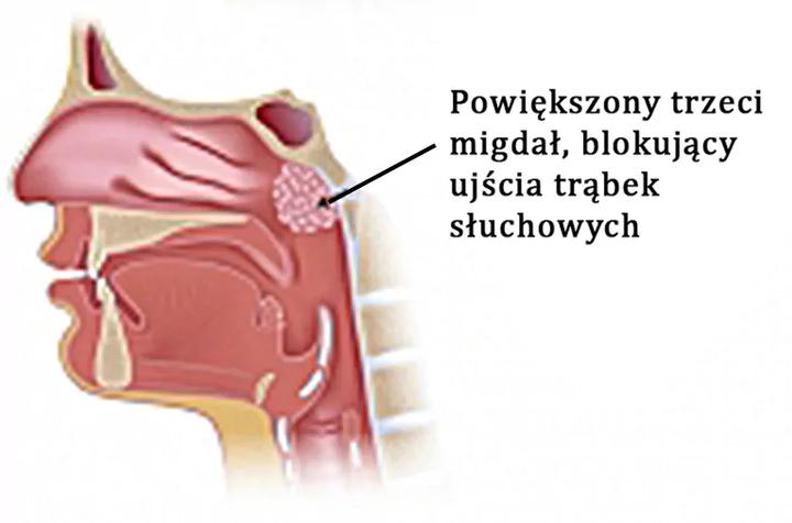 Jak rozpoznać, czy dziecko ma trzeci migdał? Praktyczny przewodnik dla rodziców