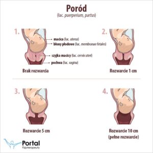 Poród naturalny po cesarce: jakie mogą wystąpić powikłania?