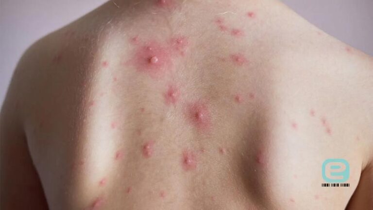 Czy warto szczepić dziecko na ospę wietrzną? Oto co musisz wiedzieć